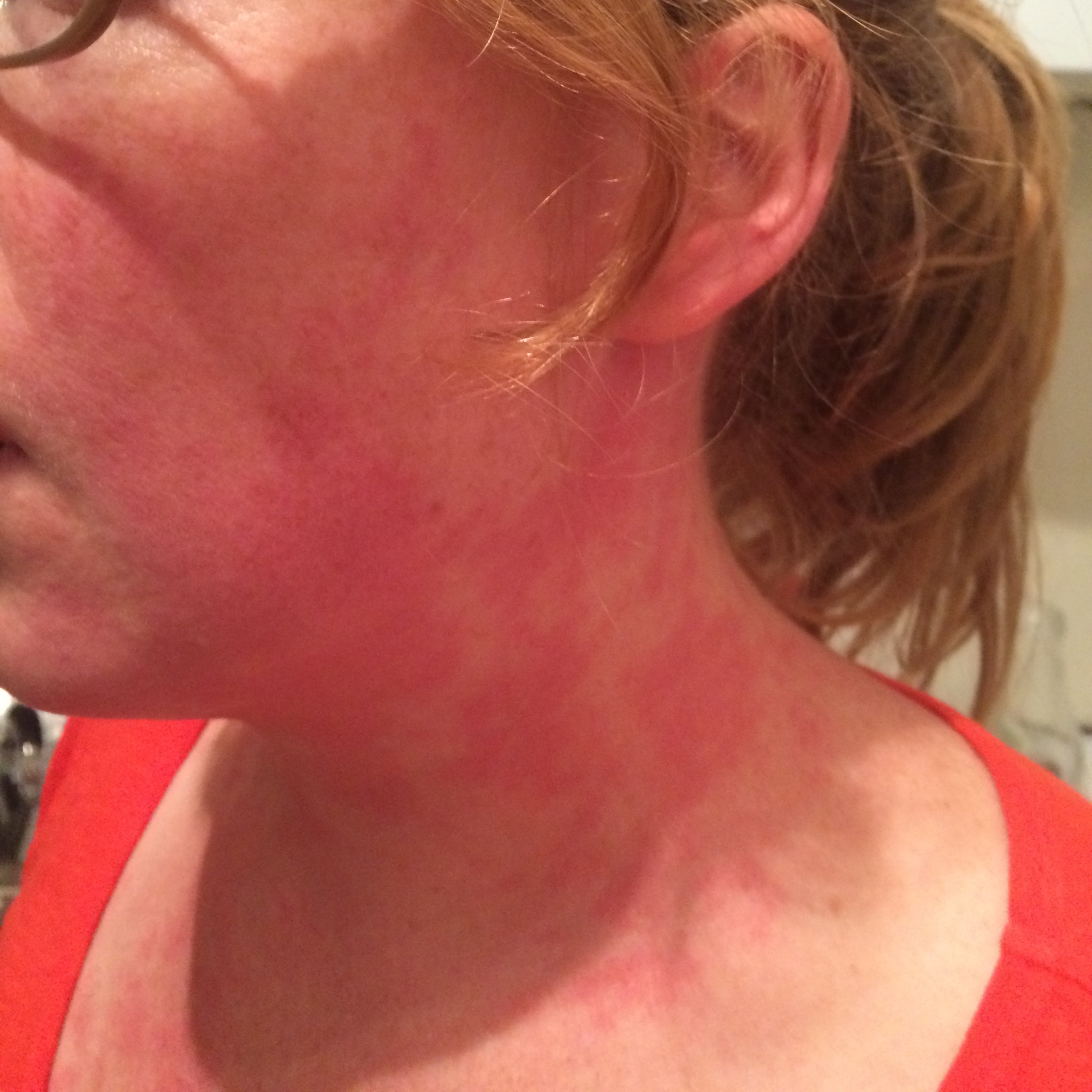 Chest and Neck rash - Dermatology - MedHelp